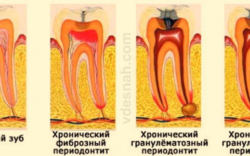 Лечение периодонтита Томск Урицкого стоматология детская поликлиника томск